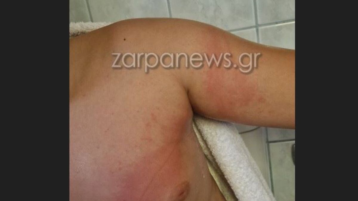 Χανιά: 11χρονος τσιμπήθηκε από θαλάσσια ανεμώνη και γέμισε με εξανθήματα