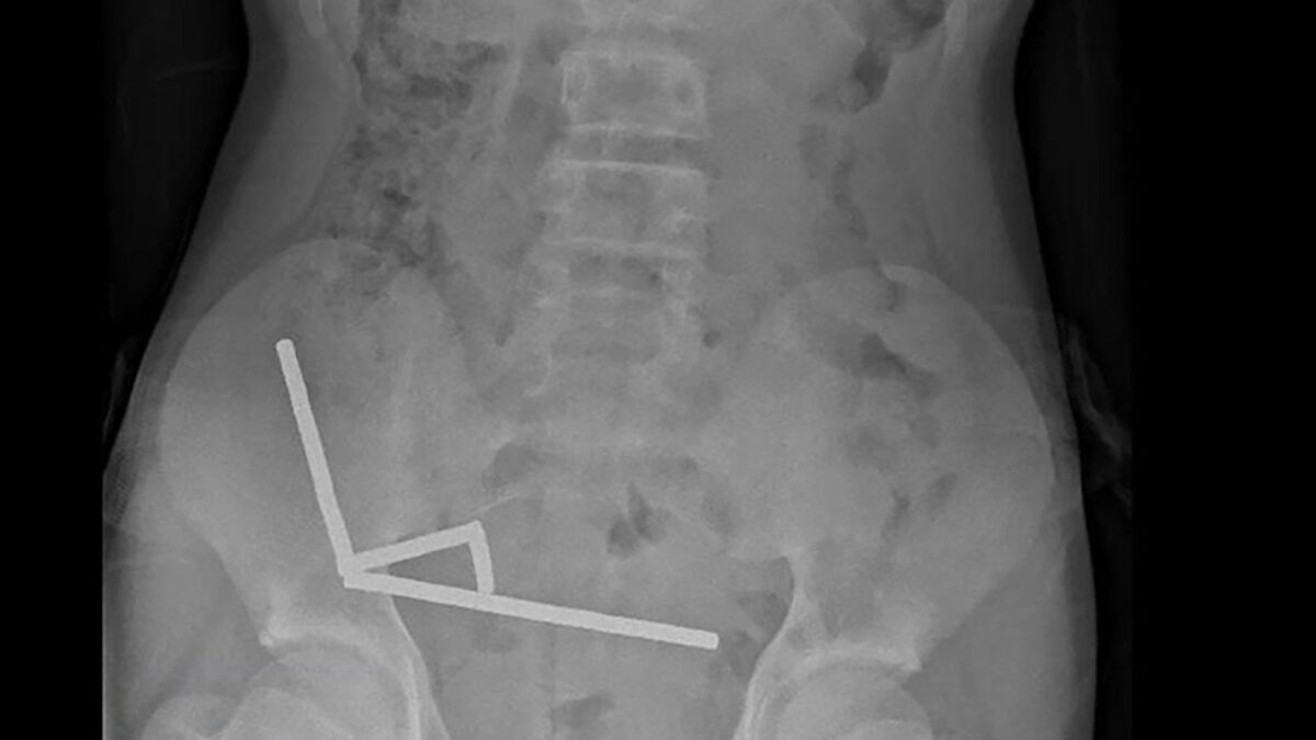 Νέα Ζηλανδία: Γιατροί αφαιρούν δεκάδες μαγνήτες από έντερο 13χρονου