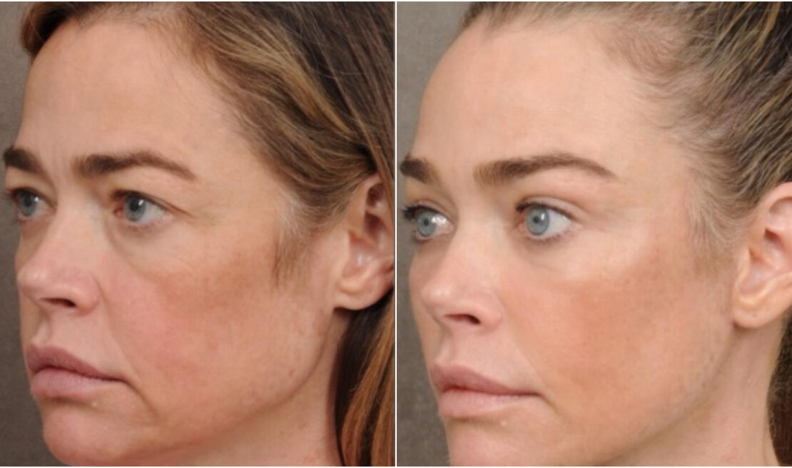 Ντενίζ Ρίτσαρντς: Εντυπωσιακή αλλαγή στο πρόσωπο μετά από λίφτινγκ – Δείτε τη διαφορά