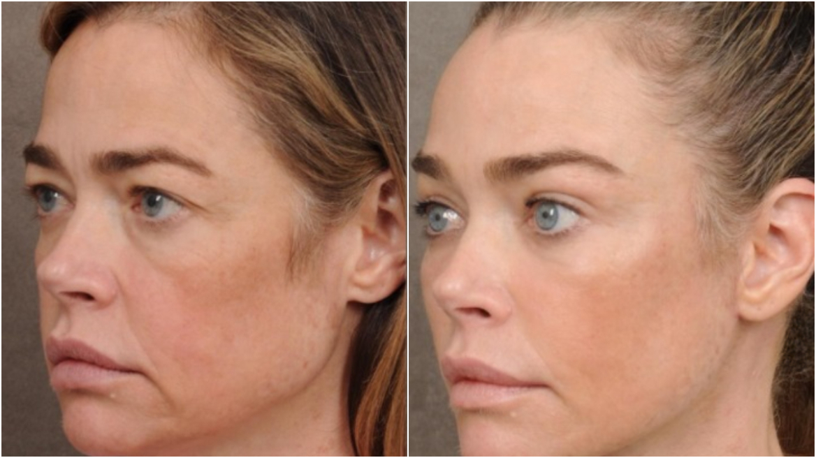 Ντενίζ Ρίτσαρντς: Εντυπωσιακή αλλαγή στο πρόσωπο μετά από λίφτινγκ – Δείτε τη διαφορά