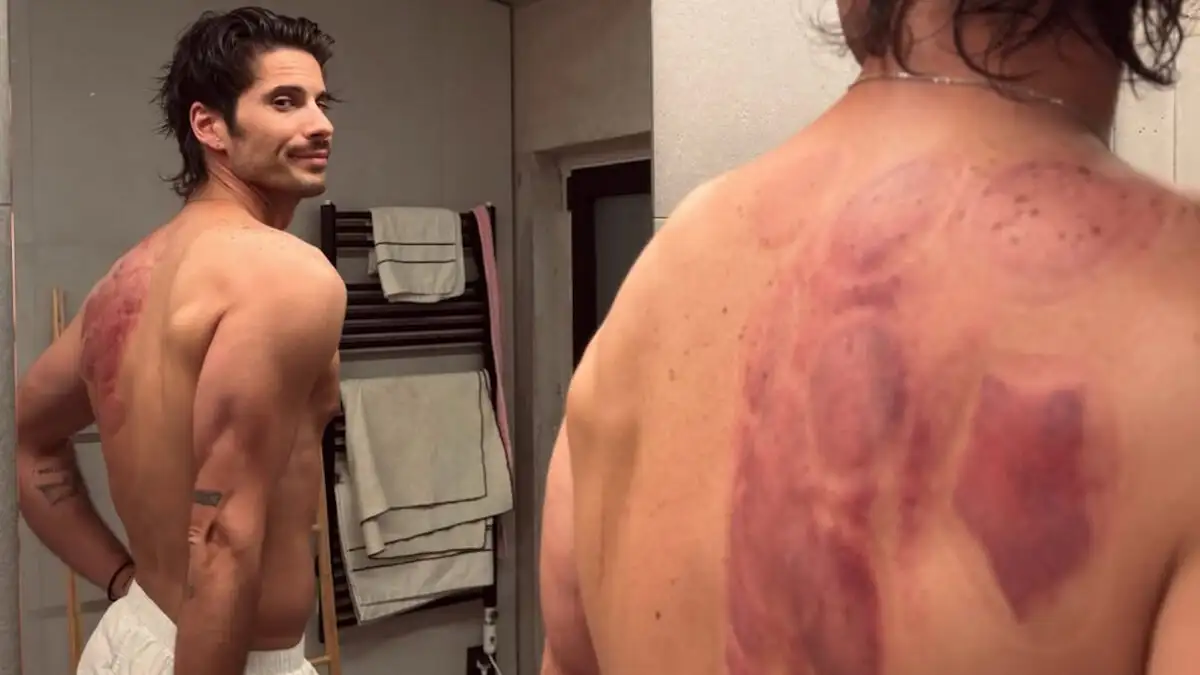 Ο Γιώργος Καράβας αποκάλυψε το πρόβλημα που έχει στην ωμοπλάτη – Κάνει βεντούζες για να θεραπευτεί